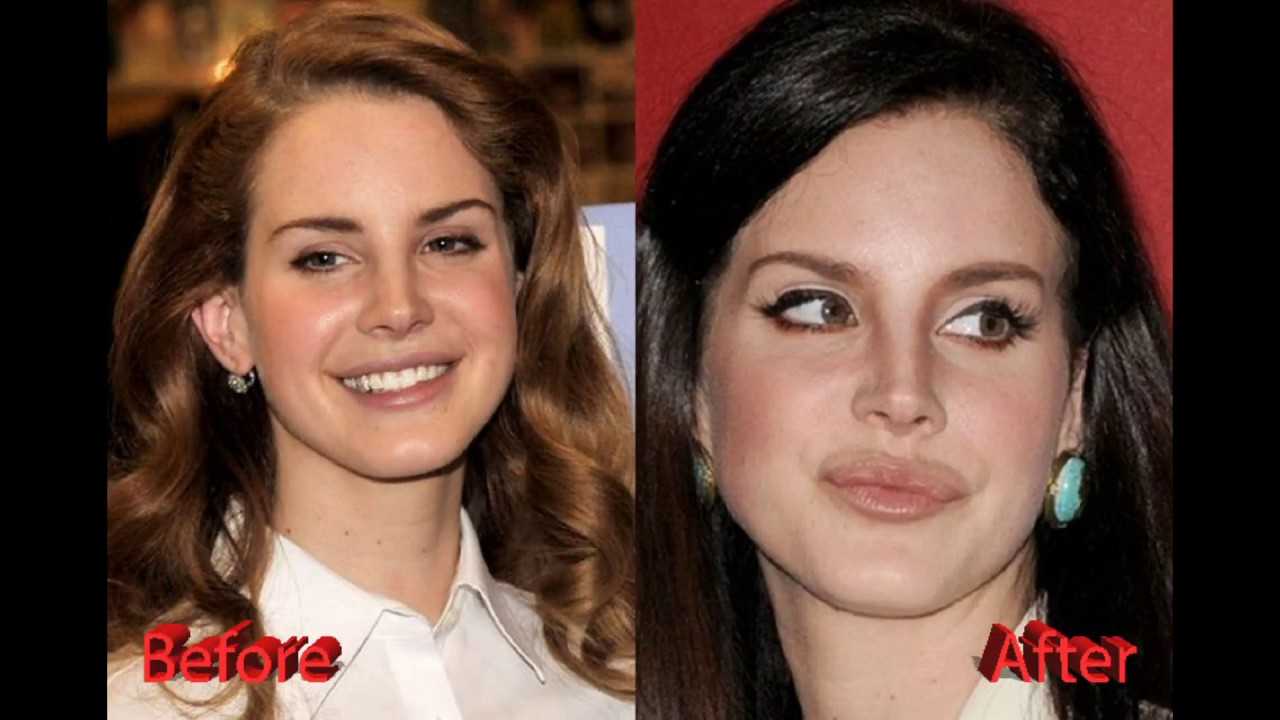 Lana del rey before and after plastic surgery: nose, lips